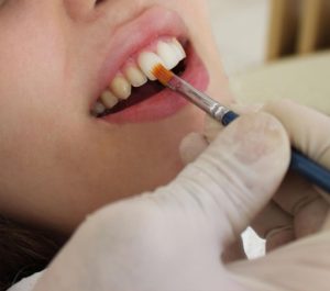Dental process