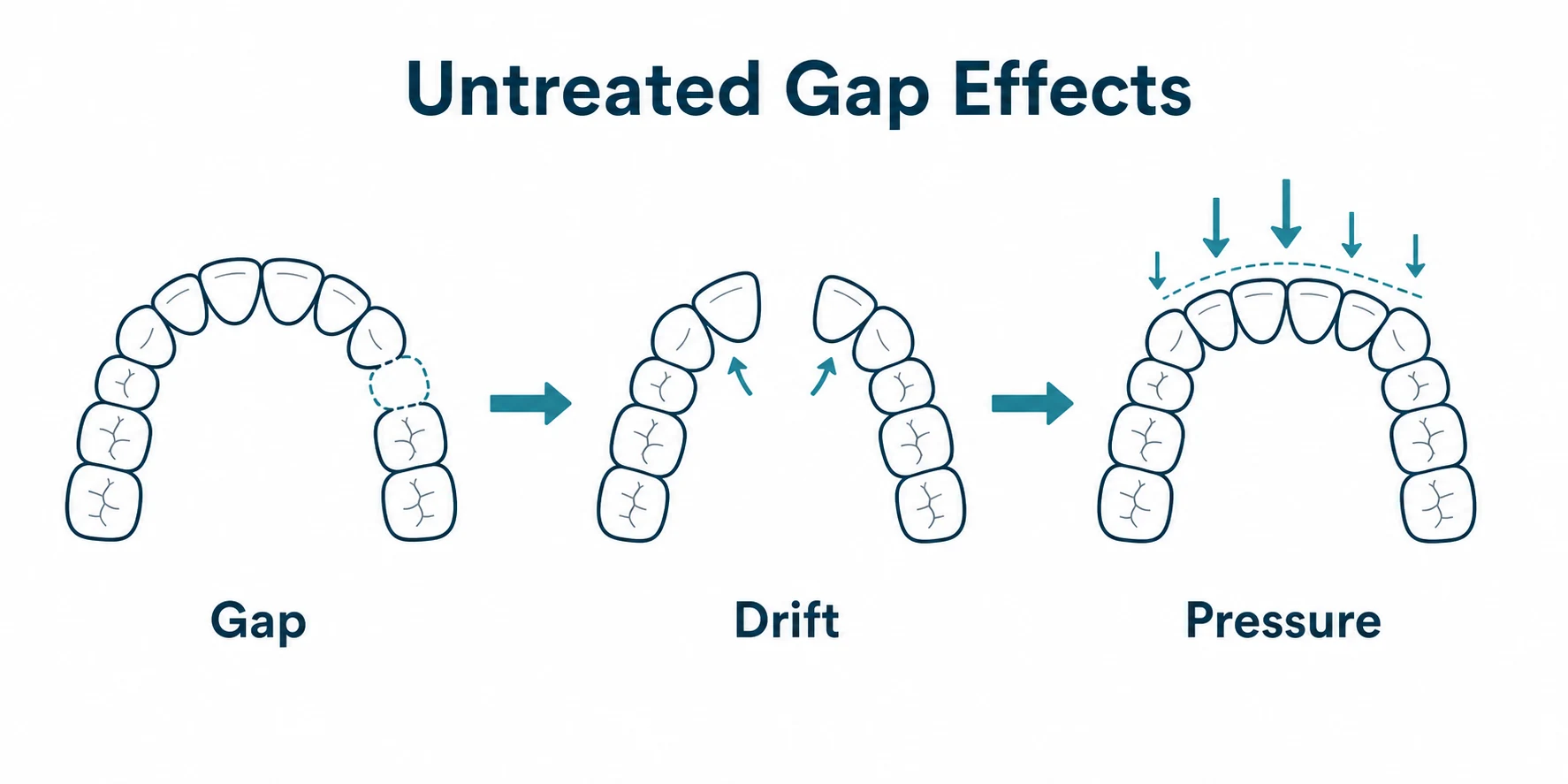 Graphic showing possible effects of leaving a tooth gap untreated.