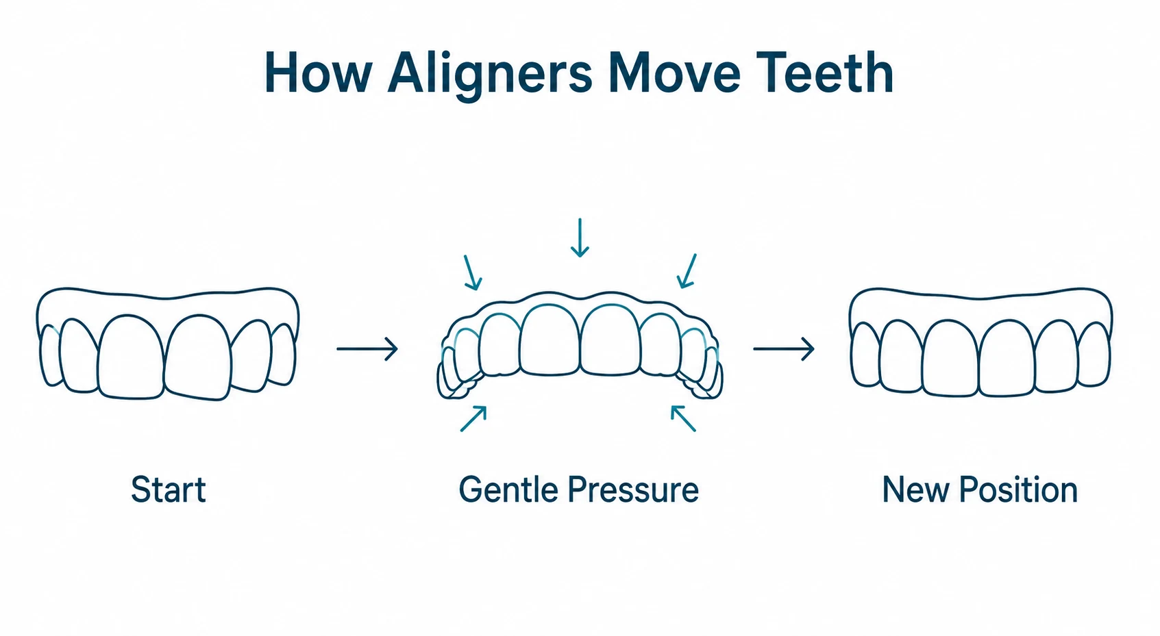 Graphic showing clear aligners moving teeth with gentle pressure